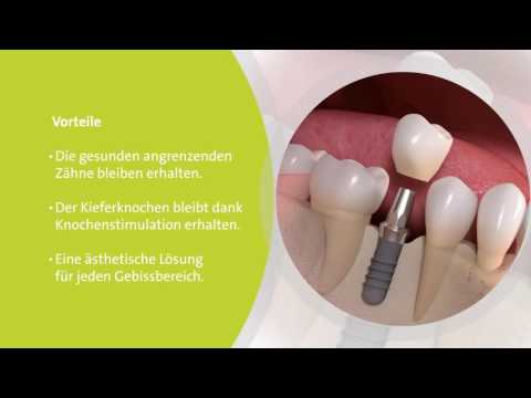 Youtube: Implantatgetragene L&ouml;sungen bei Zahnl&uuml;cken